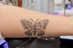 Νότια Κορέα: «Τατουάζ» νανοτεχνολογίας για την παρακολούθηση της υγείας!